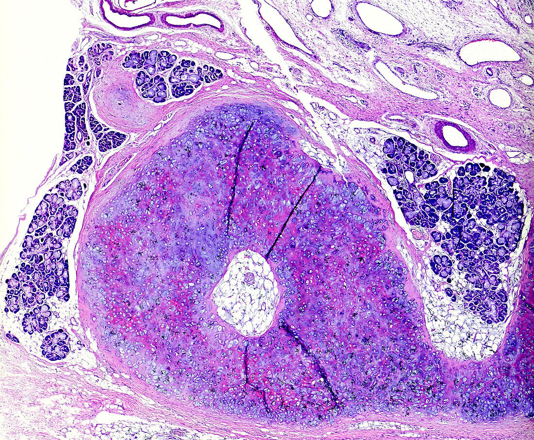 Throat cancer, light micrograph