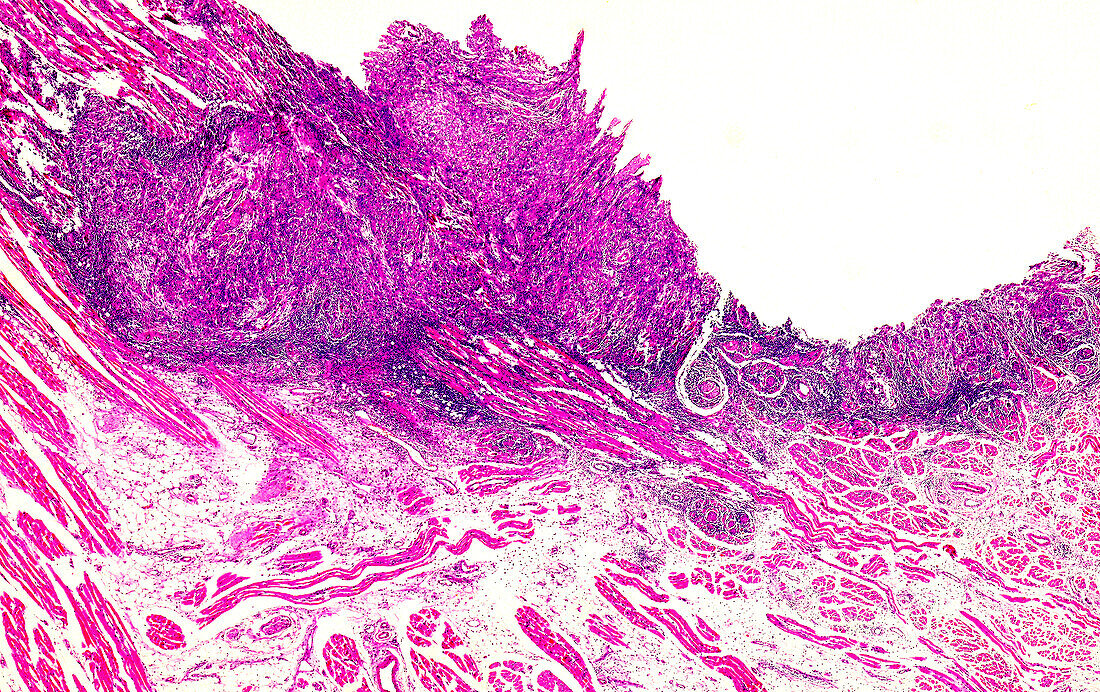 Oropharyngeal cancer, light micrograph