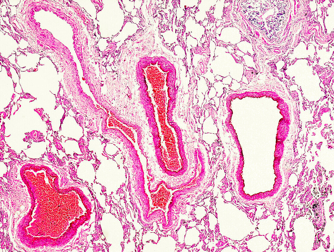 Acute alveoli emphysema, light micrograph