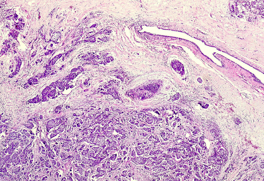 Male breast cancer, light micrograph