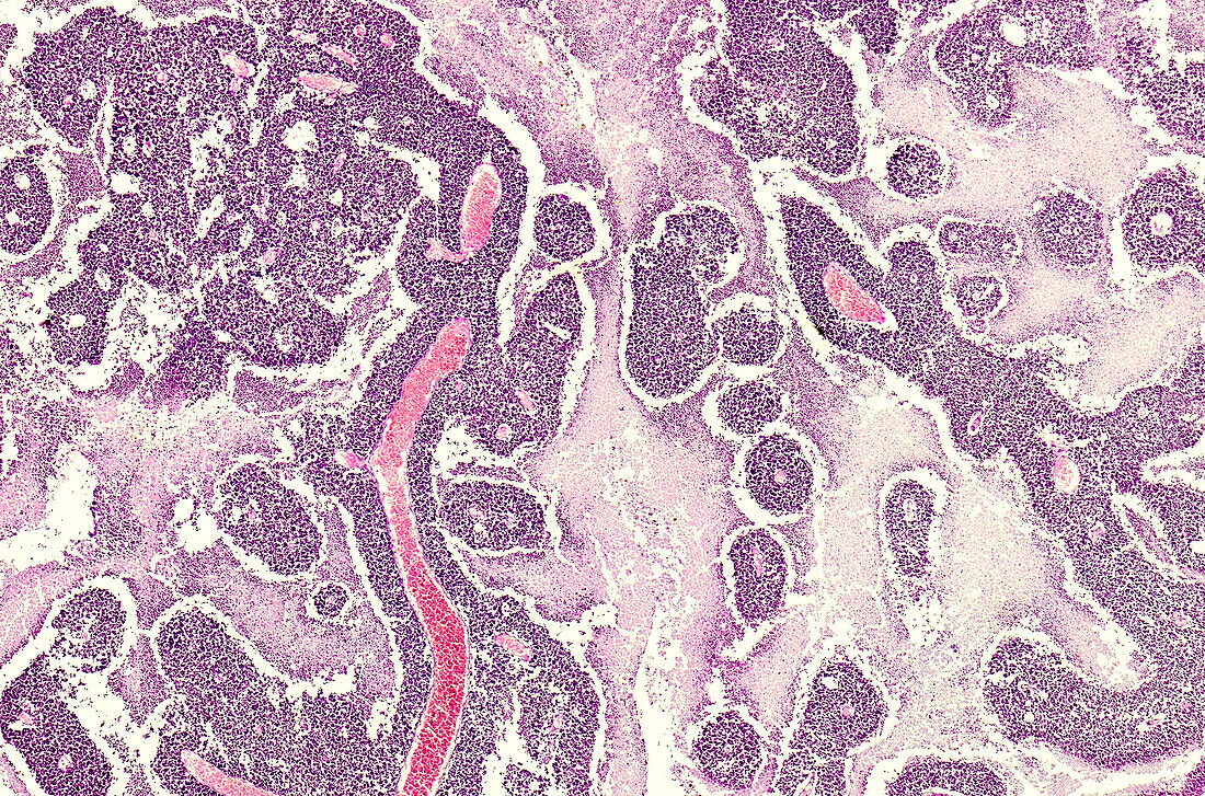 Pituitary gland tumour, light micrograph