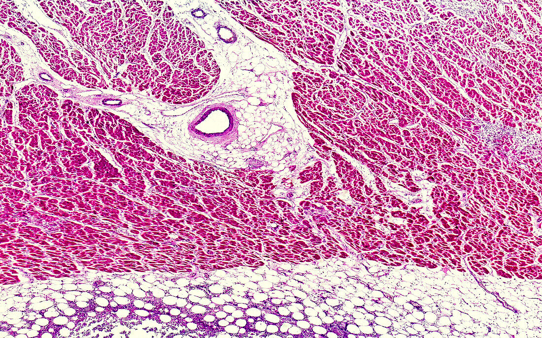 Parenchymatous myocarditis, light micrograph