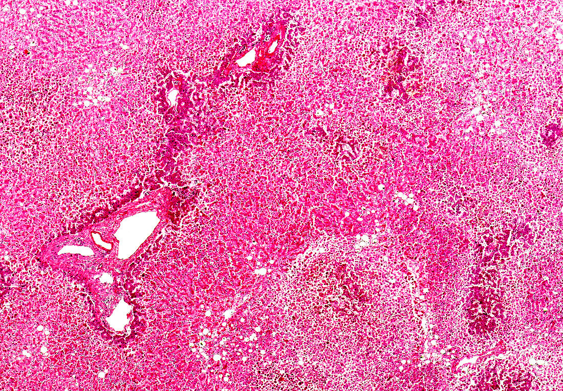 Chronic venous congestion of the liver, light micrograph