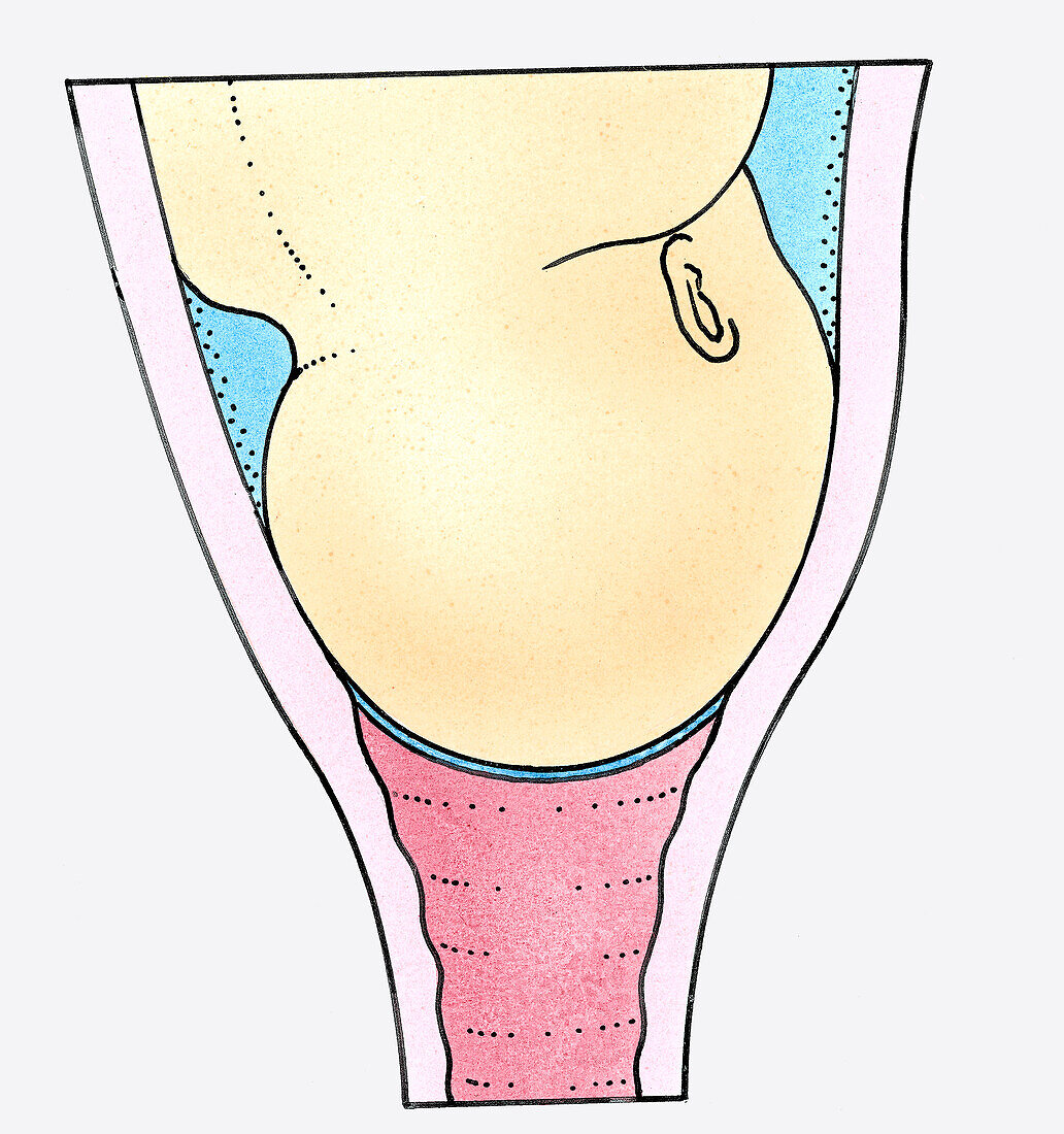 Baby's head resting on a fully dilated cervix, illustration