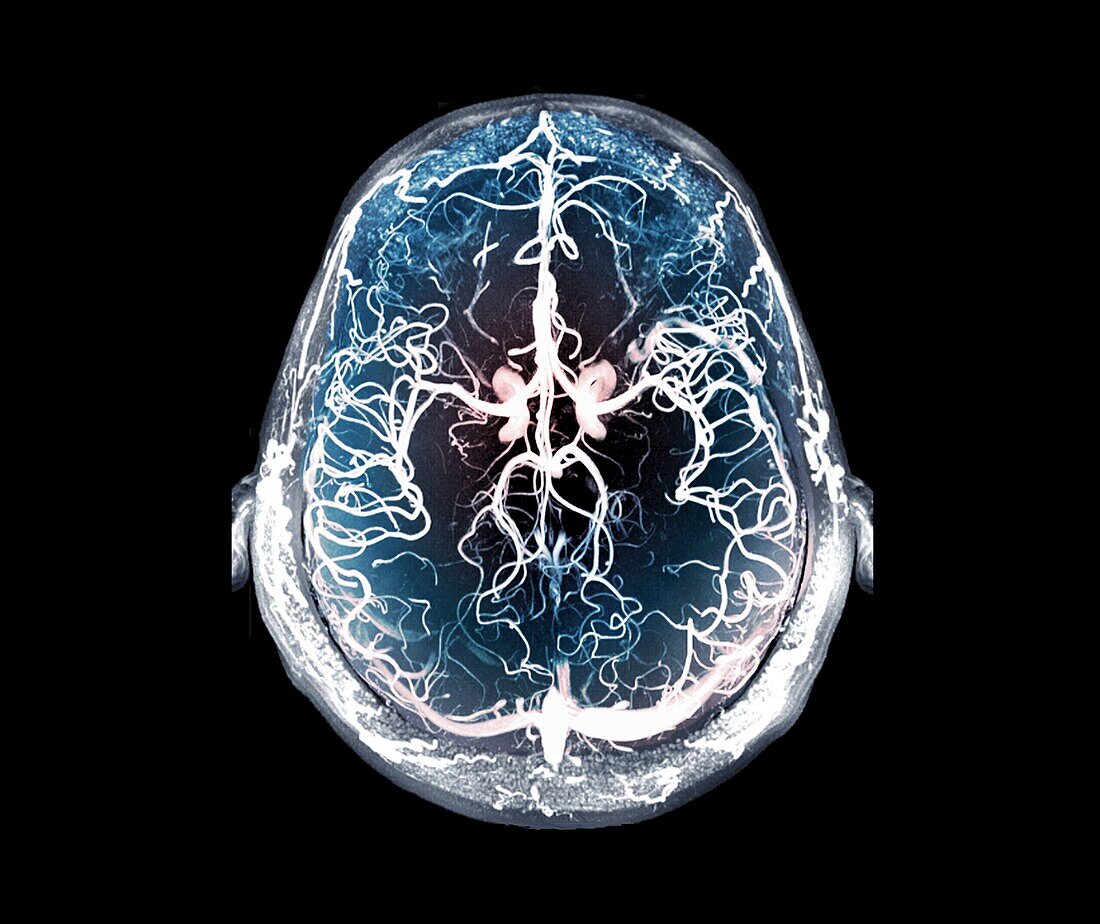 Blood vessels of the brain, MRI angiography