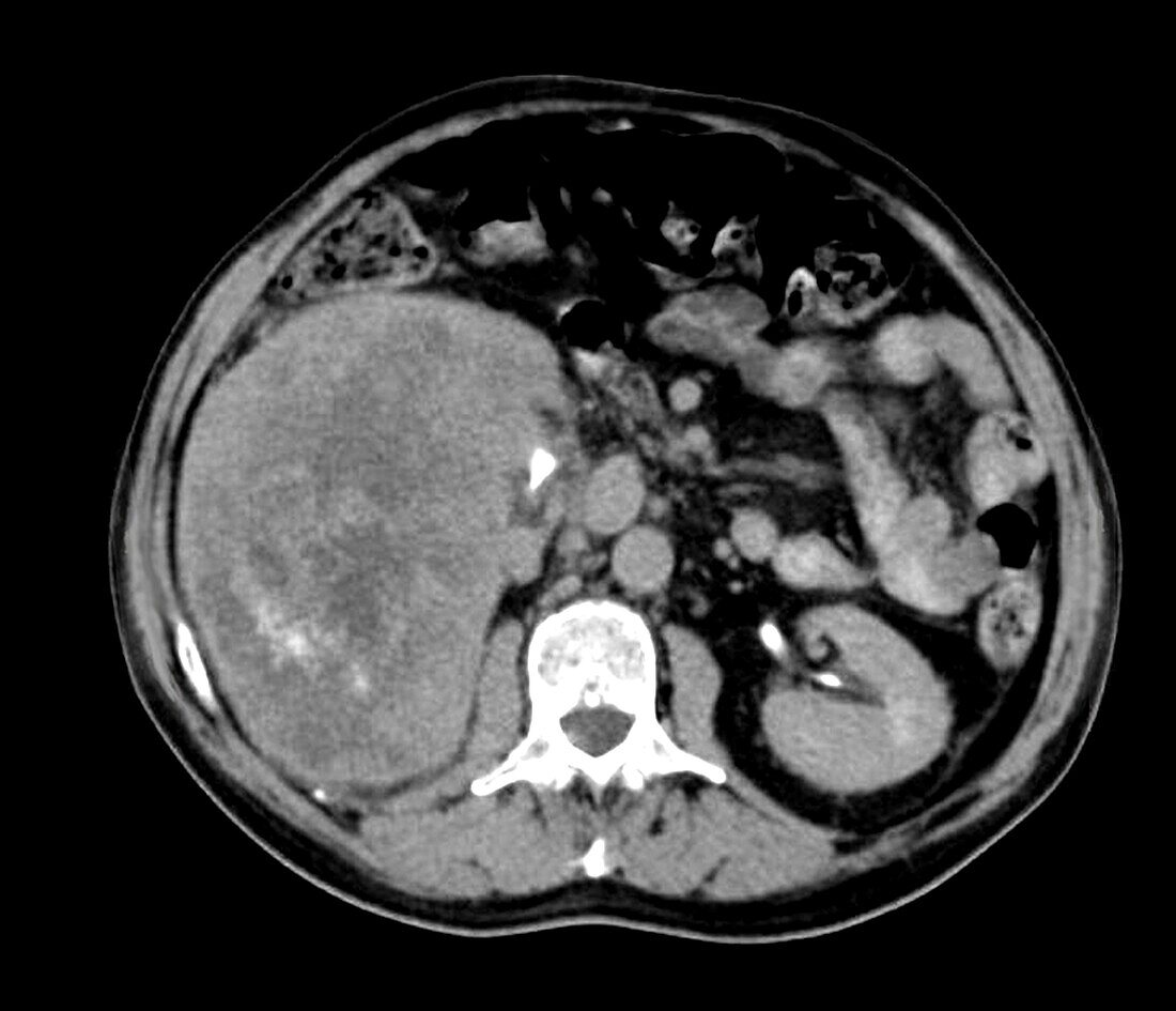 Kidney cancer, CT scan