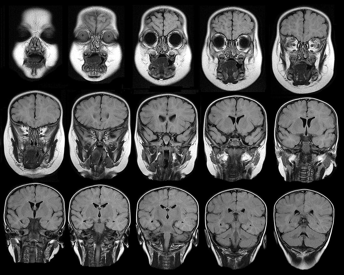 Child brain, MRI scans