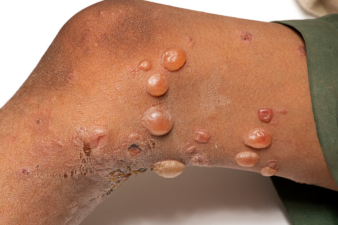 Pemphigus vulgaris lesions