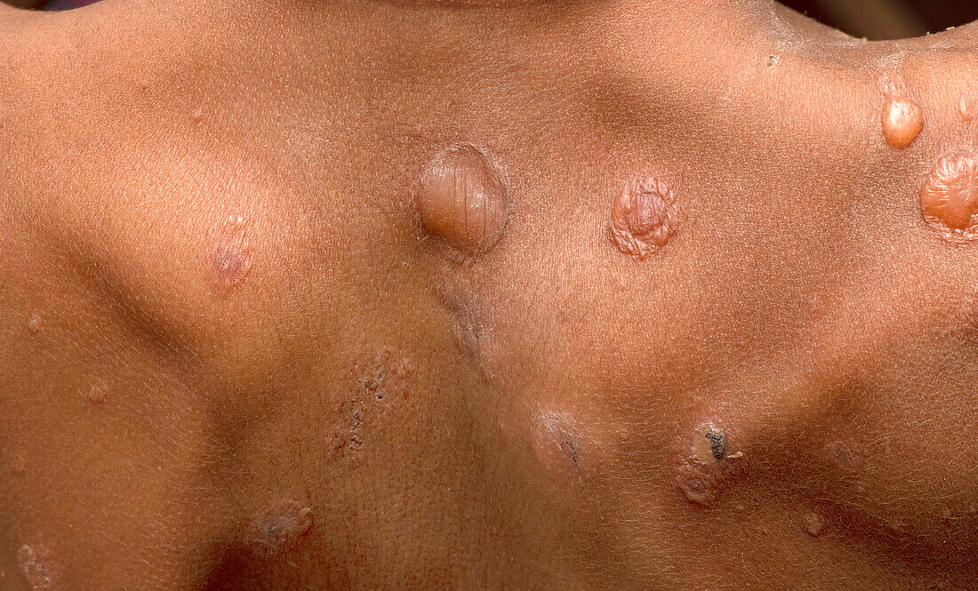 Pemphigus vulgaris lesions