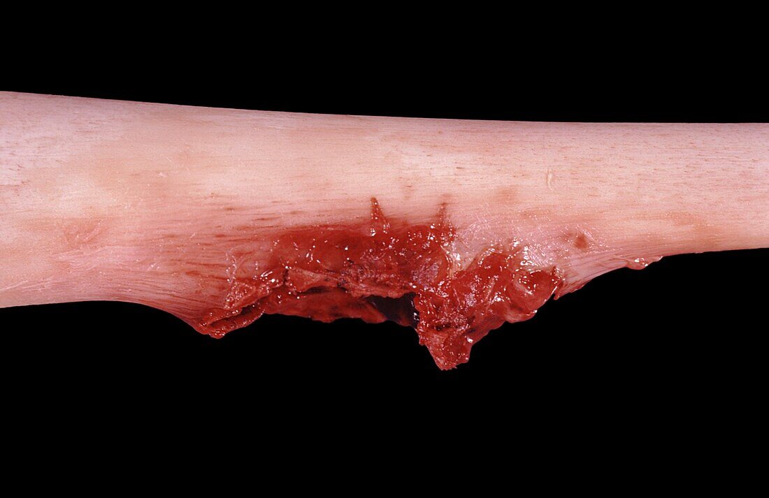 Osteosarcoma of the thigh bone