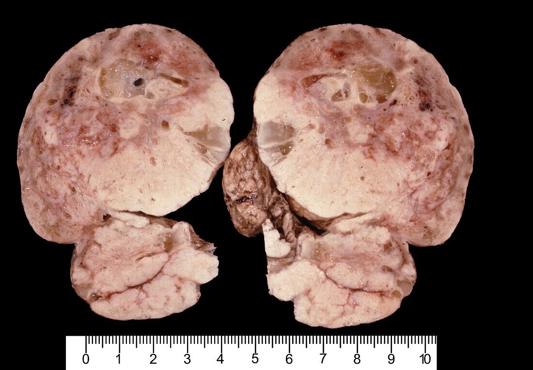 Granulosa cell tumour of the ovary