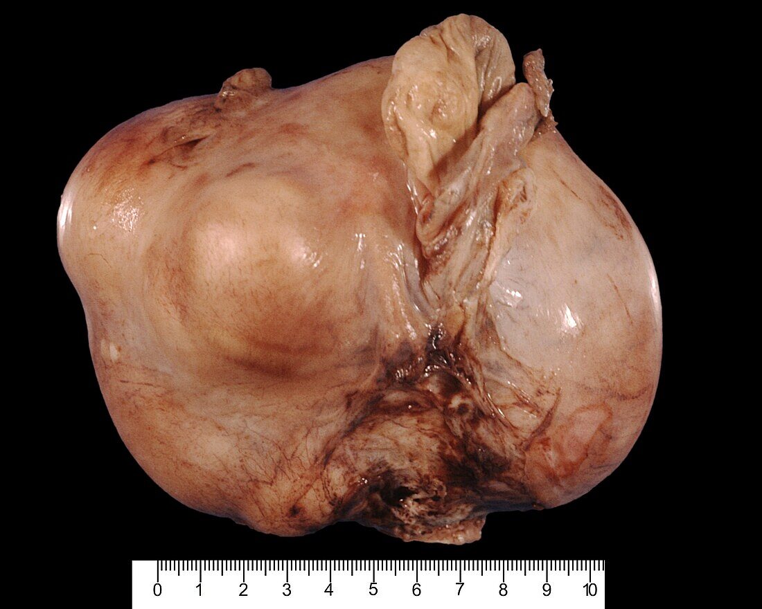 Uterine fibroids