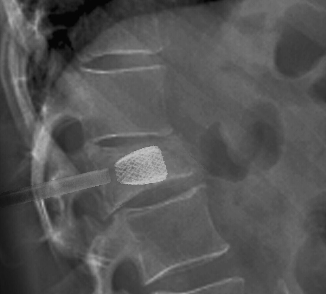 Stent in lumbar spine, X-ray