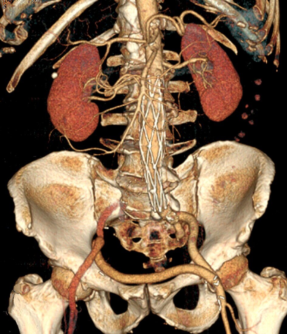Aortic abdominal aneurysm, 3D CT scan