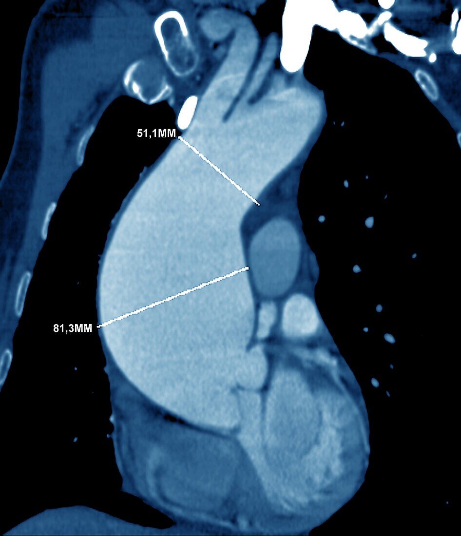 Aortic aneurysm, CT scan