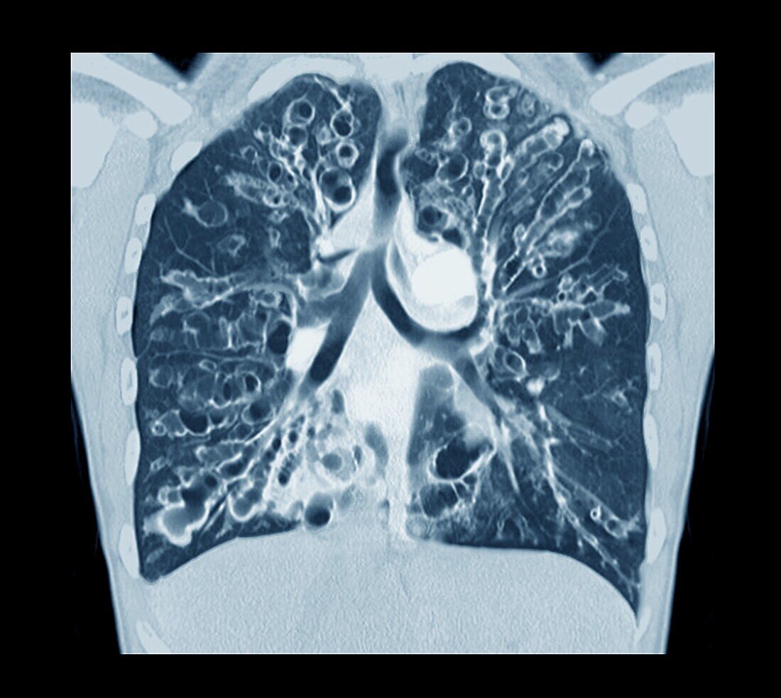 Cystic fibrosis, CT scan
