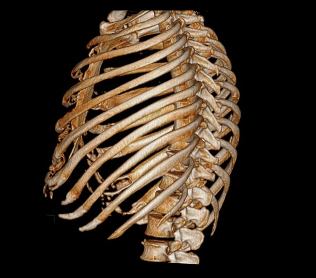 Rib cage, 3D CT scan
