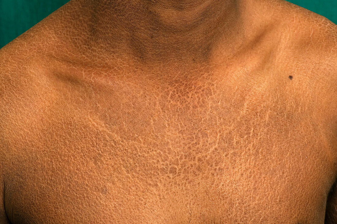 X-linked ichthyosis