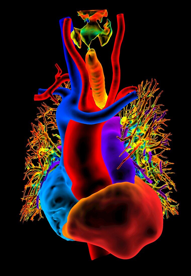 Congenital heart defect, 3D CT scan