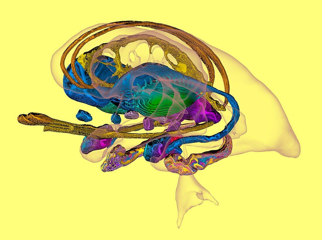 Limbic system in Alzheimer's disease, 3D MRI scan