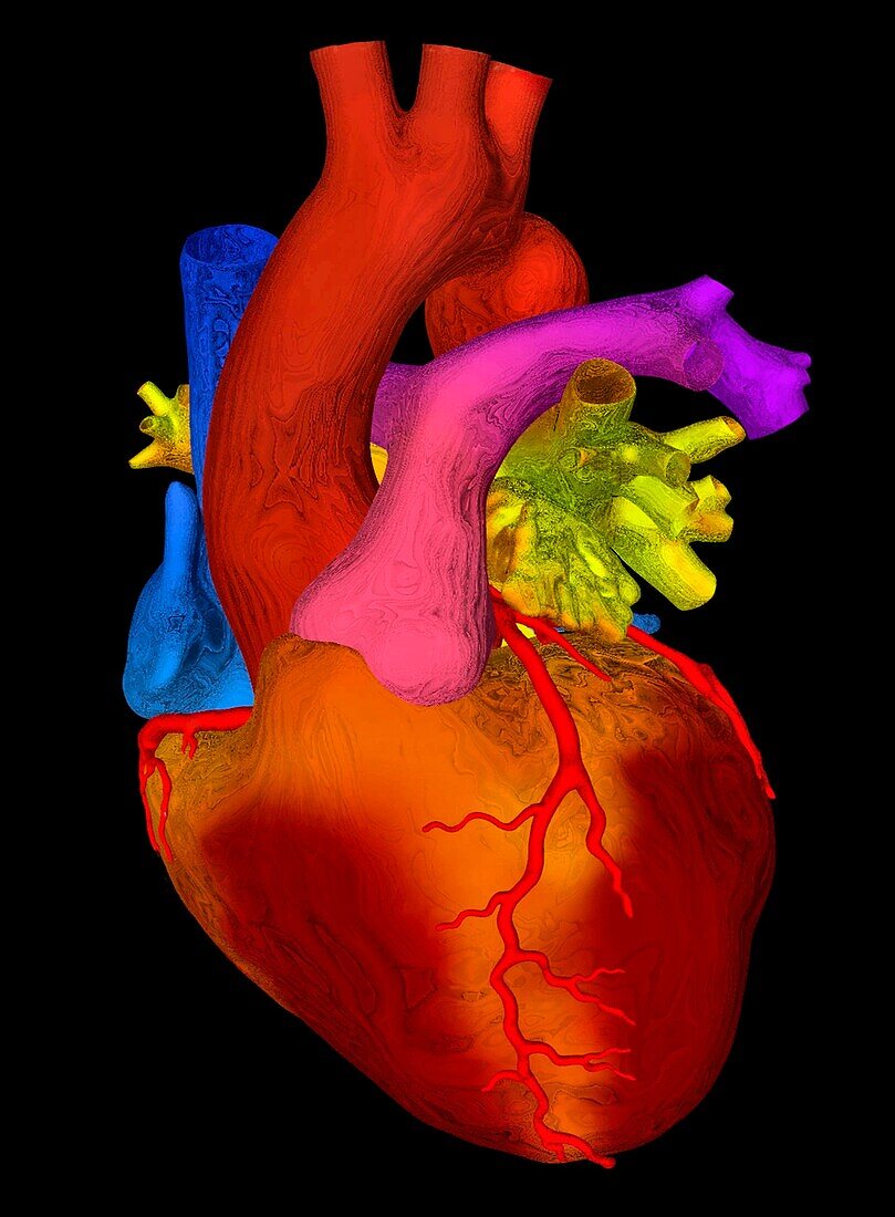 Congenital heart defect, 3D CT scan