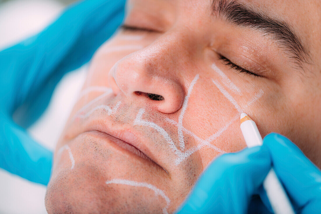 Marking face before filler treatment