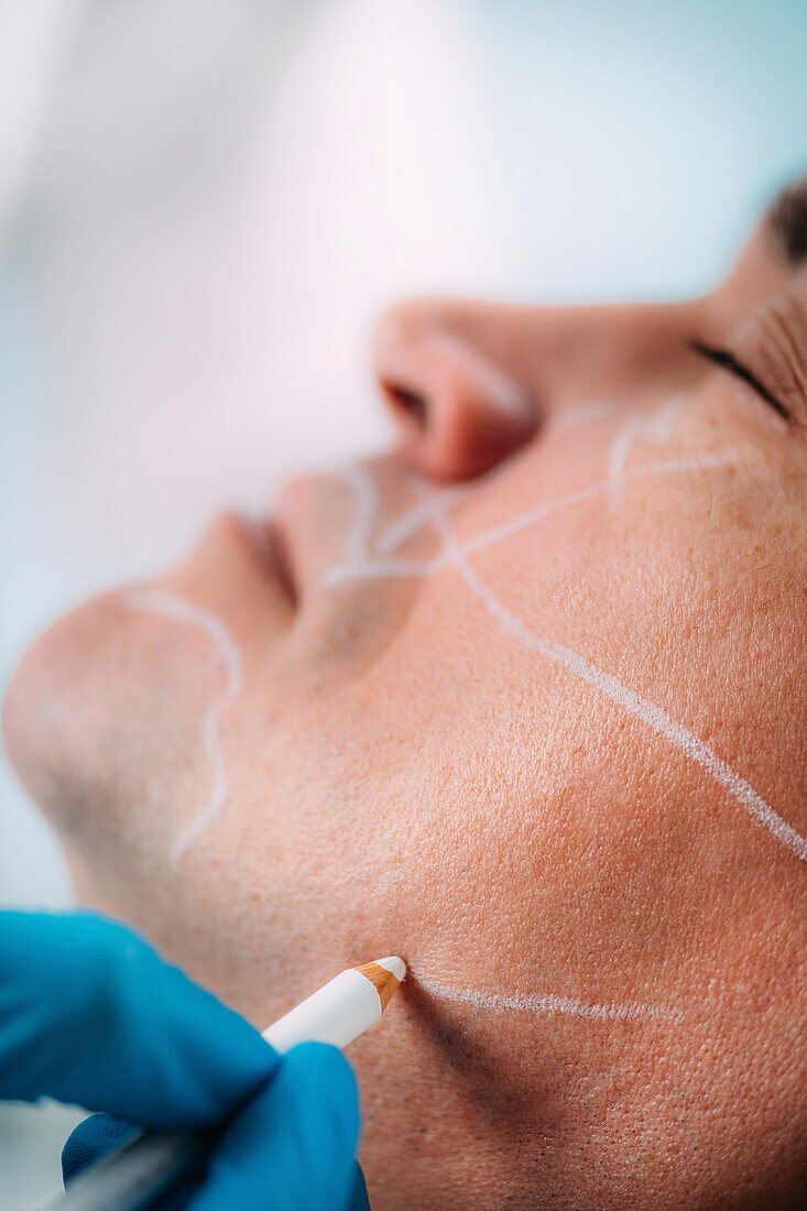 Marking face before filler treatment