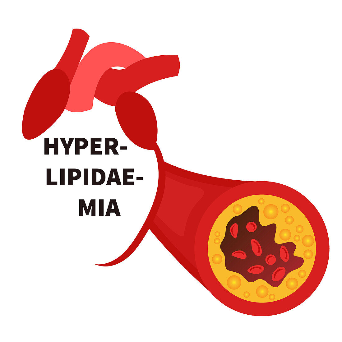 Hyperlipidaemia, conceptual illustration