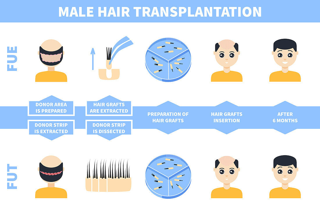 Hair transplantation in men, illustration