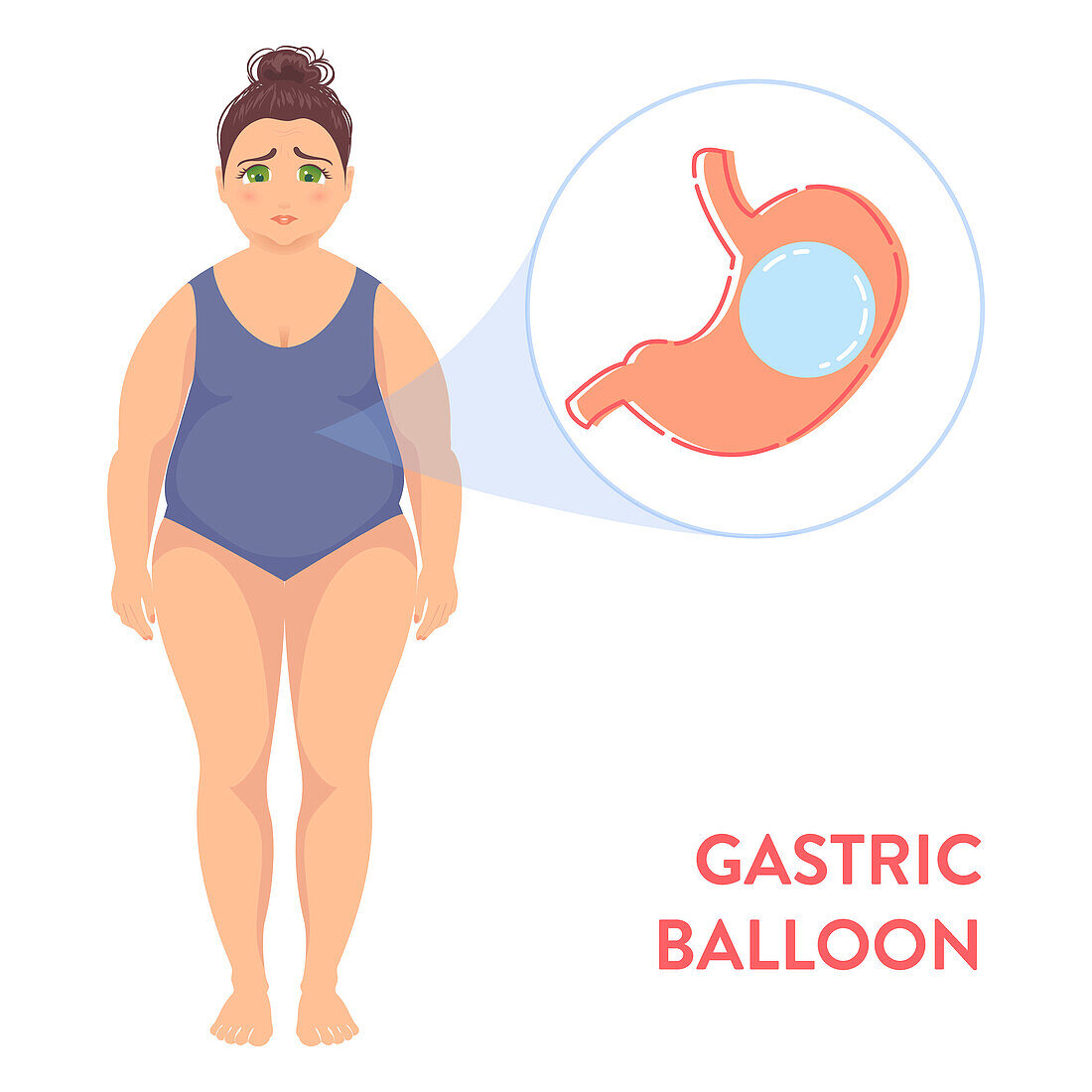 Gastric balloon, conceptual illustration