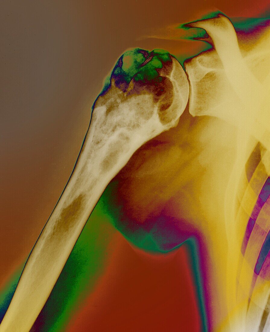 Aneurysmal bone cyst, X-ray