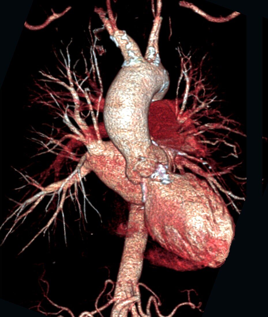Aortic aneurysm, 3D CT angiogram scan