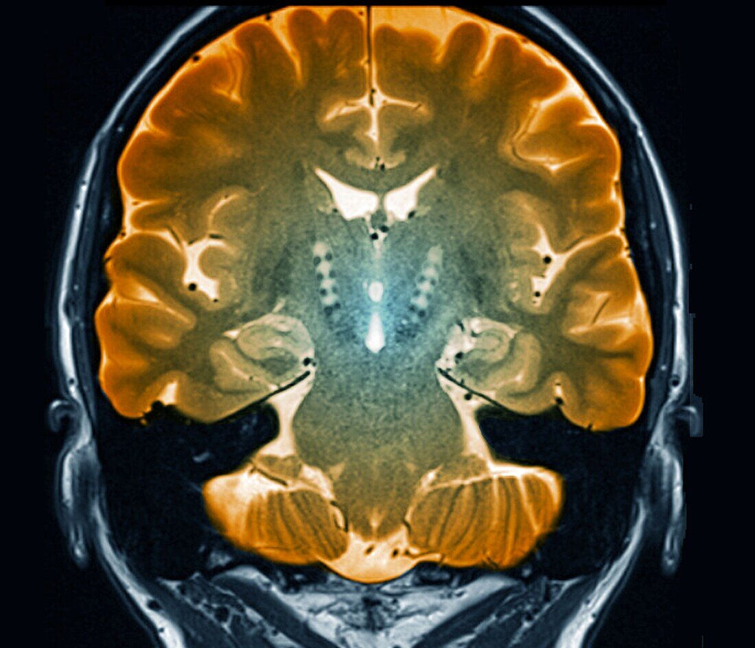 Parkinson's disease, MRI scan
