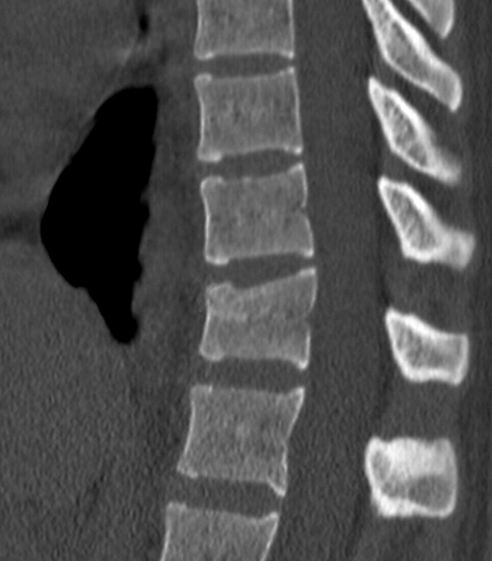 Thoracic spine, CT scan