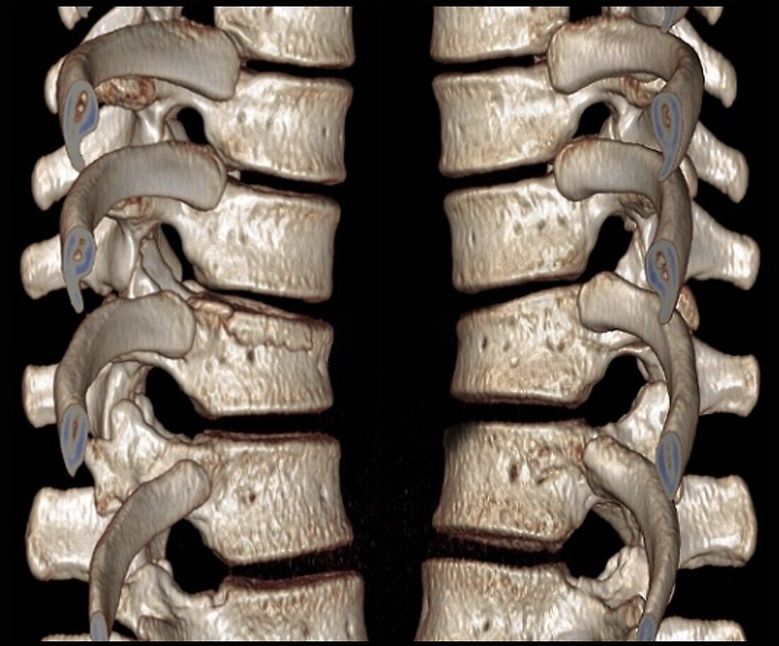 Thoracic spine vertebrae, CT scan