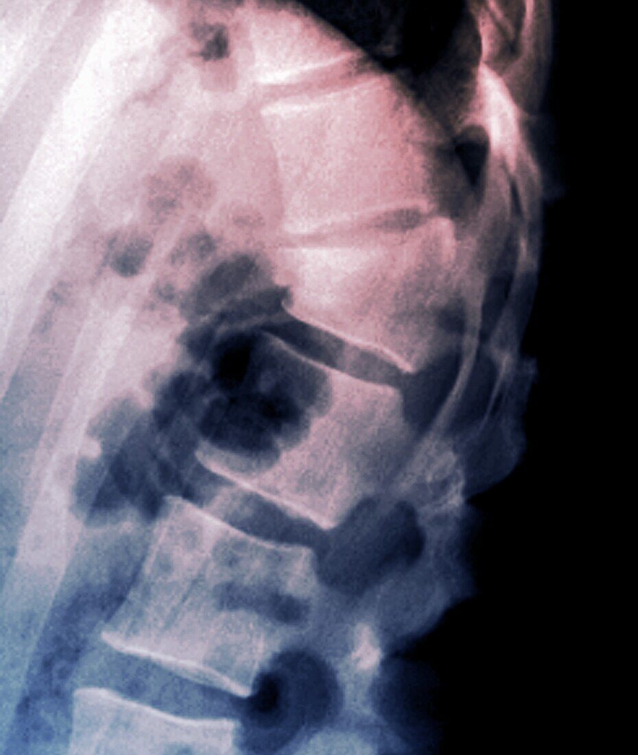 Thoracic spine fracture, X-ray