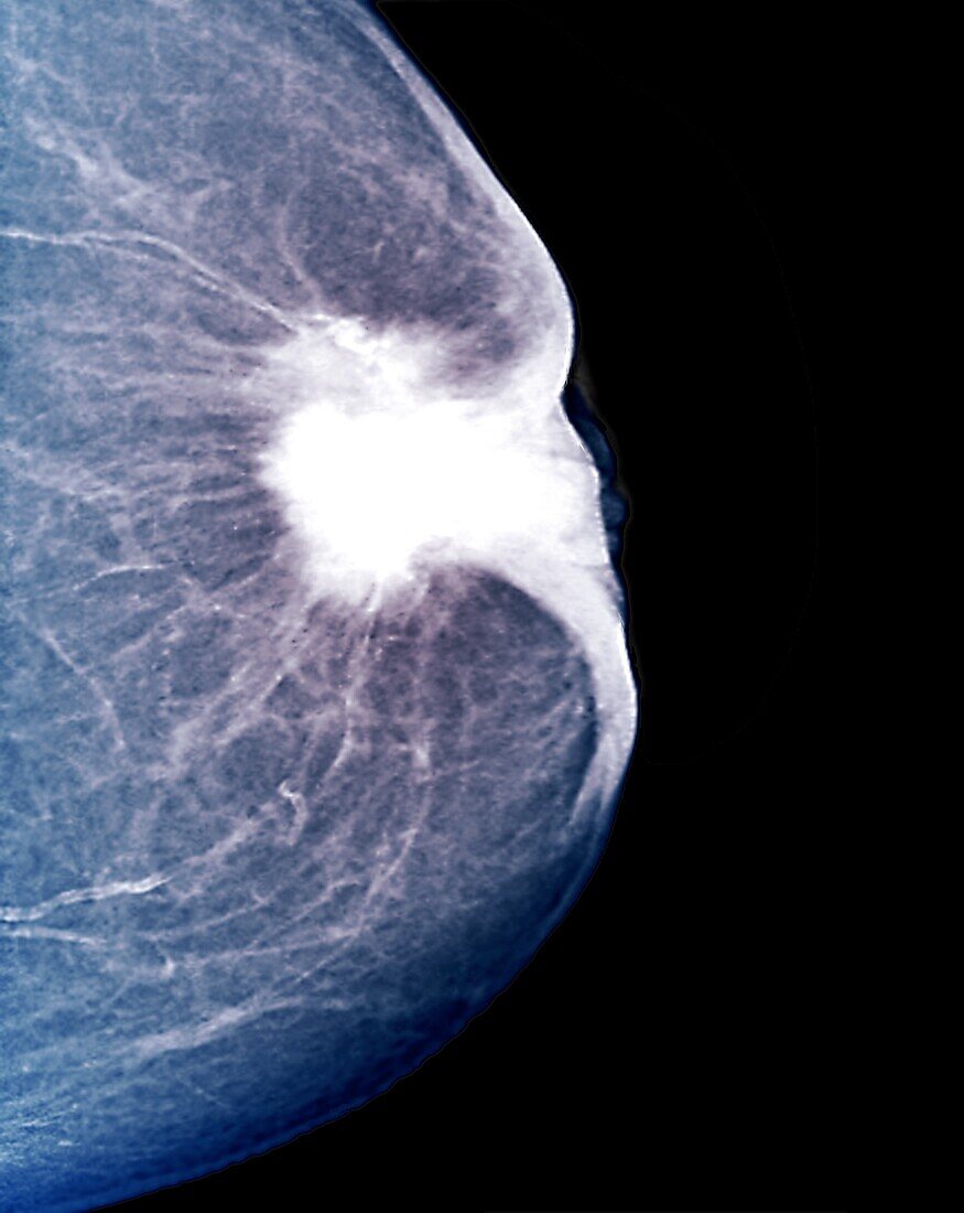 Breast lesion, X-ray