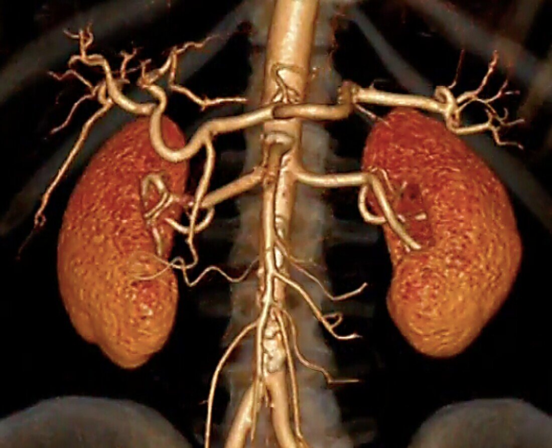 Healthy kidneys, 3D CT scan