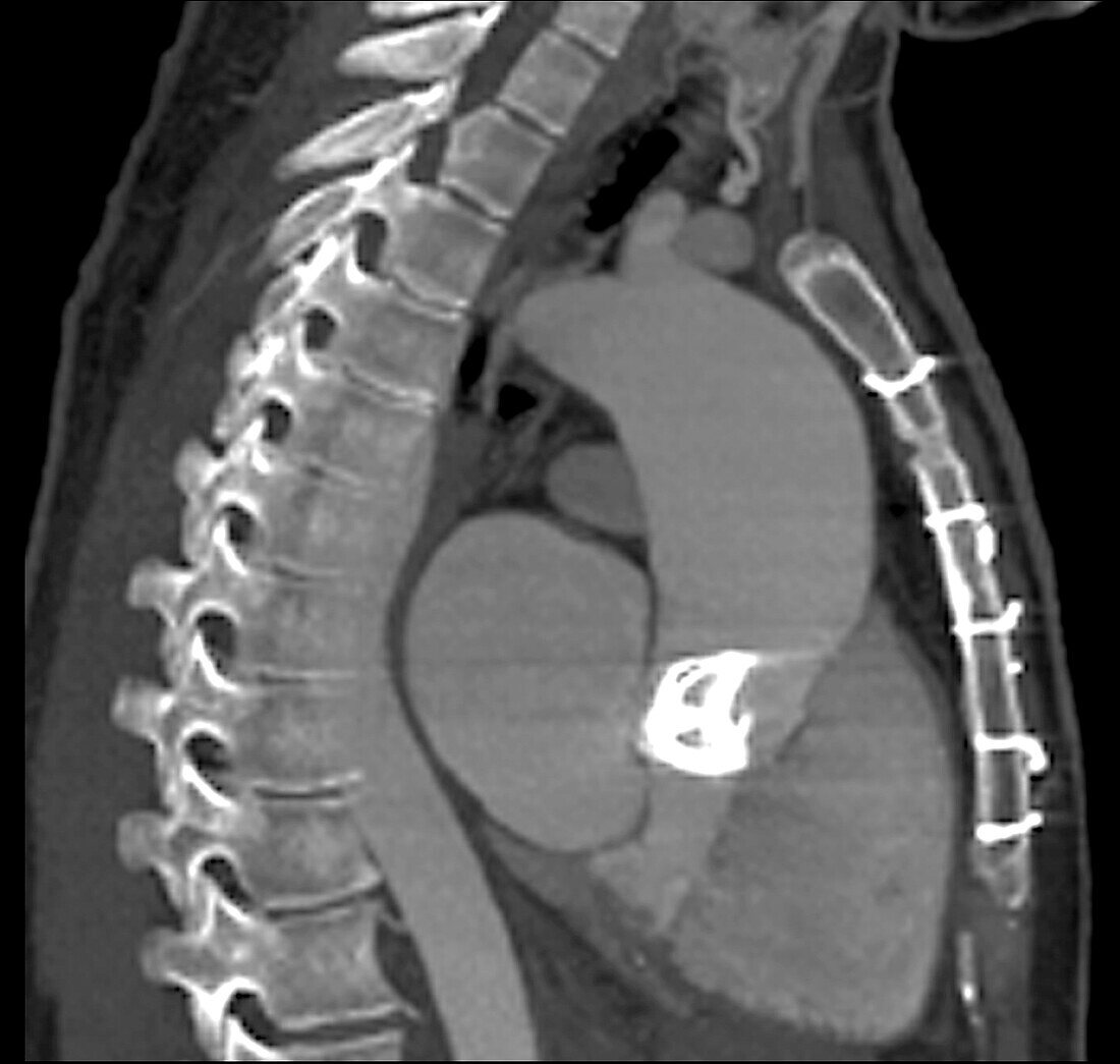 Ascending thoracic aortic aneurysm, CT scan