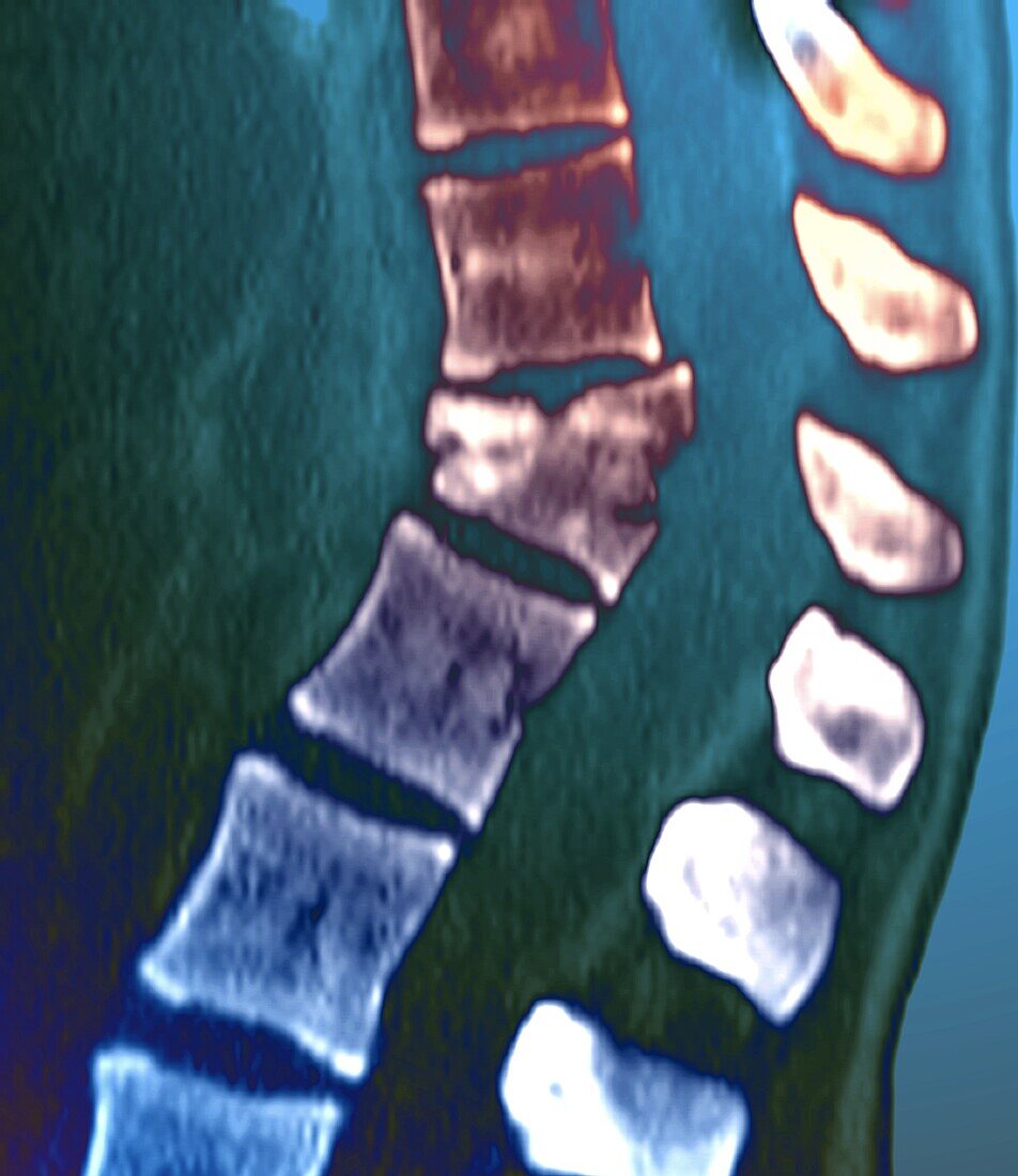 Thoracic spine fracture, CT scan