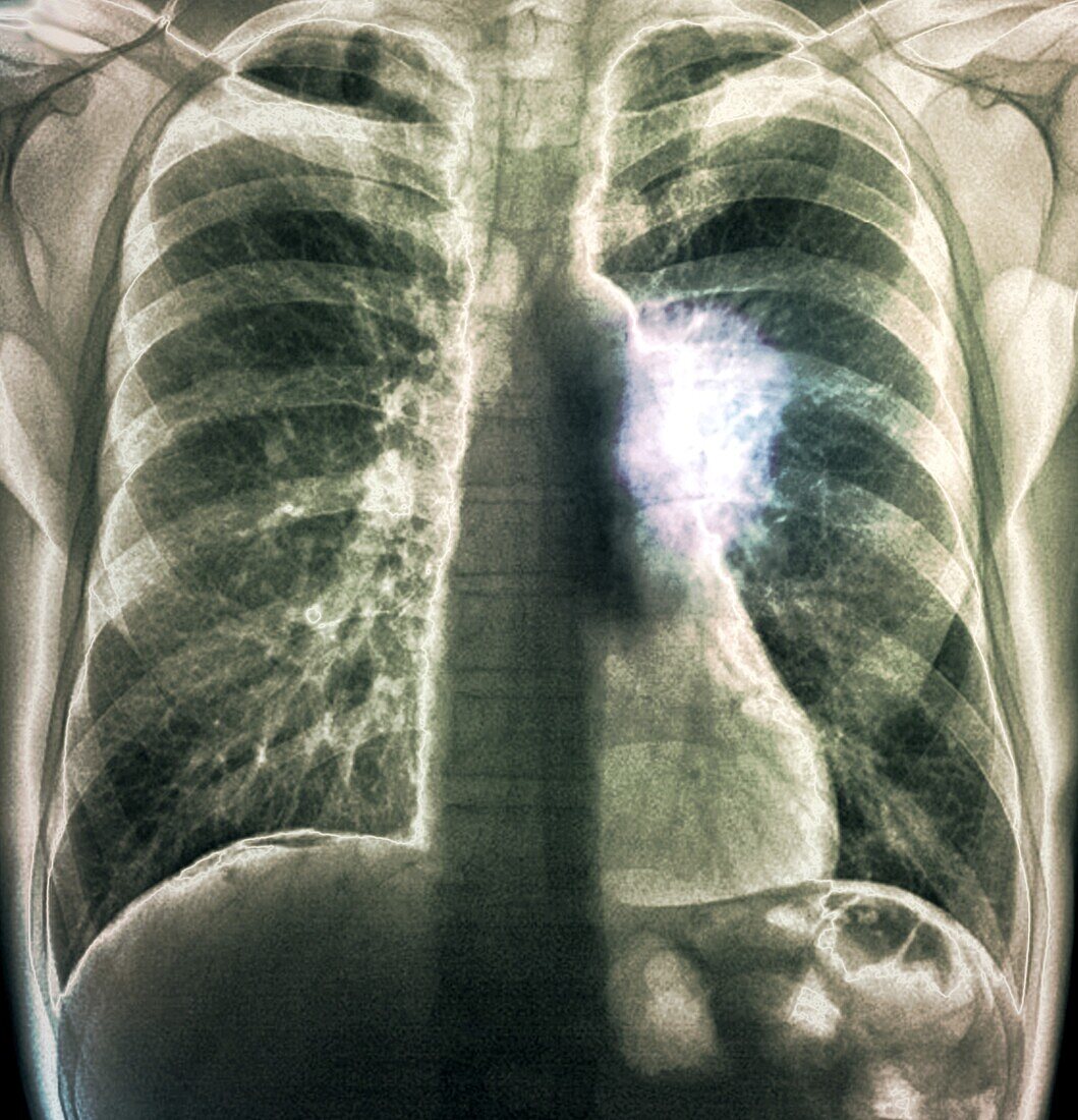 Lung cancer, X-ray