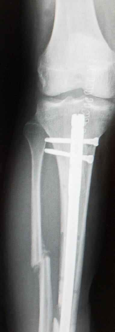 Pinned leg, X-ray