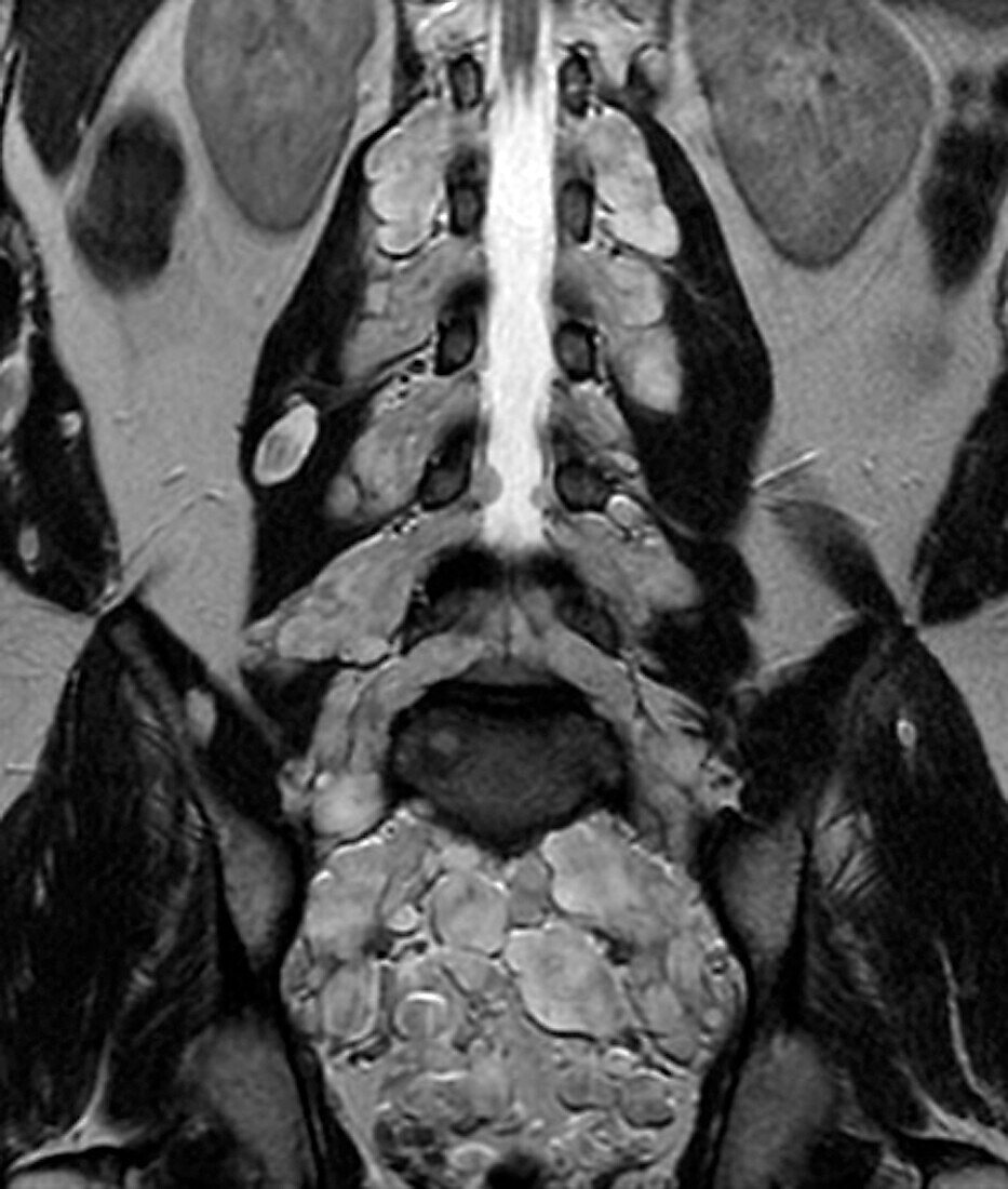 Neurofibromatosis, MRI scan