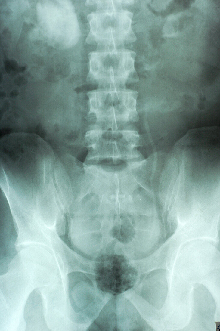 Lower spine, X-ray