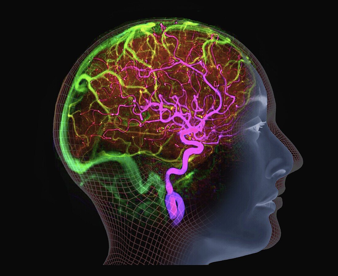 Brain blood supply, 3D CT scan