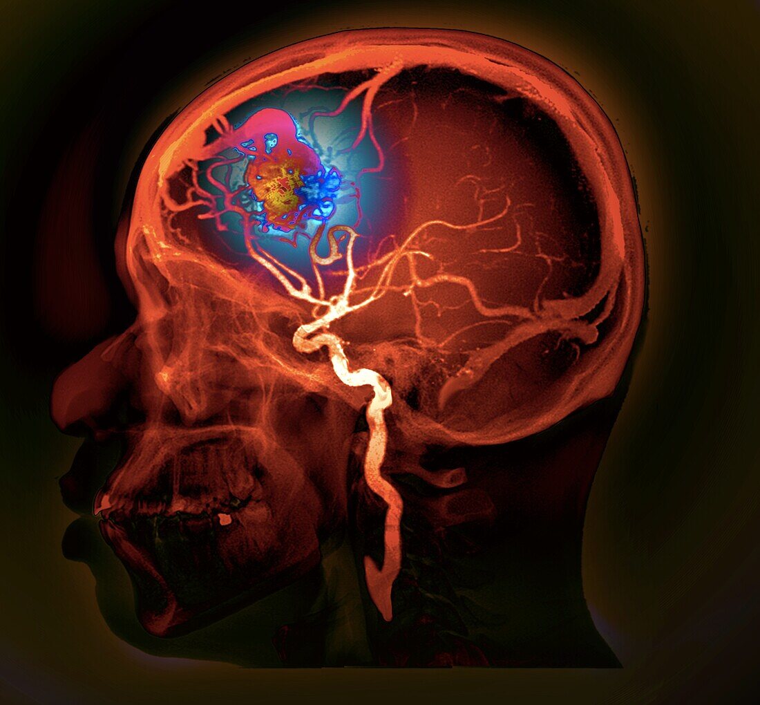 Cerebral arteriovenous malformation, CT angiogram