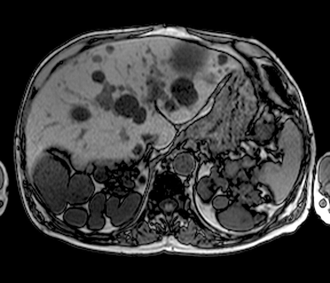 Polycystic kidney disease, MRI scan