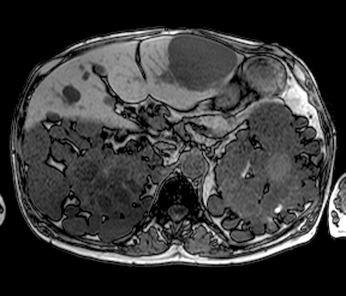 Polycystic kidney disease, MRI scan