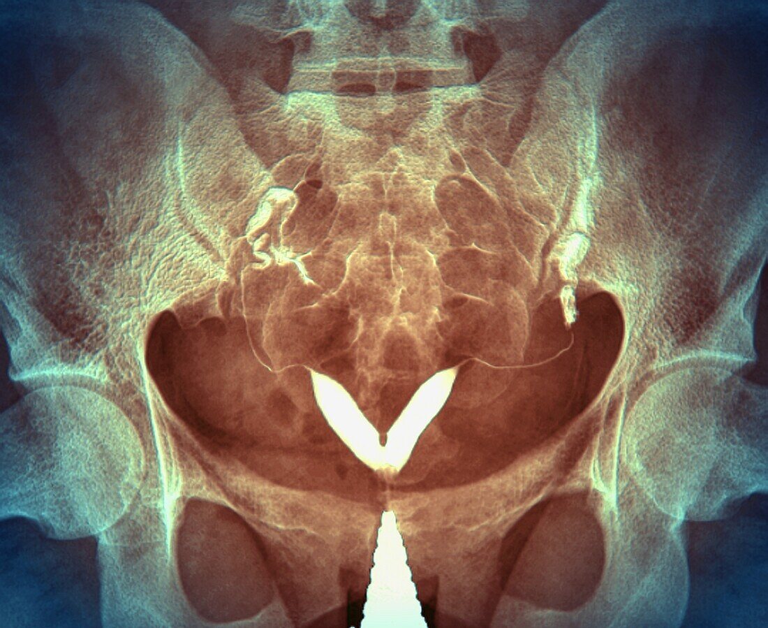 Bicornuate uterus, X-ray