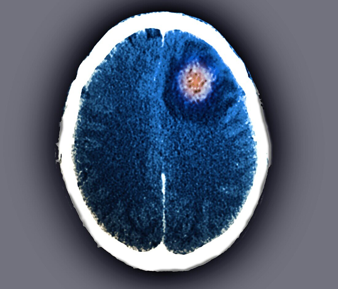 Brain abscess, CT scan